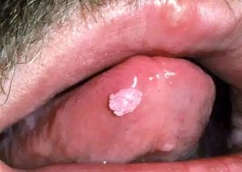 آیا زگیل تناسلی می‌تواند از طریق بزاق دهان منتقل شود؟
